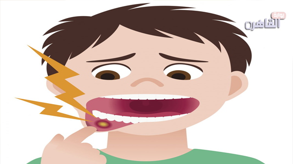 اسباب تقرحات الفم-قرحة الفم-علاج تقرحات الفم