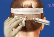 زراعة الشعر في القاهرة