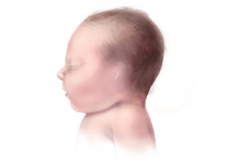 علاج تشوهات الأذن عند حديثي الولادة