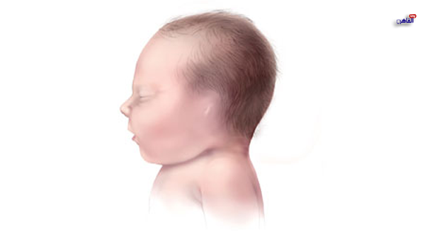 علاج تشوهات الأذن عند حديثي الولادة