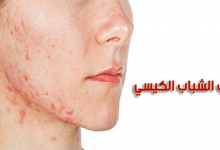 علاج حب الشباب الكيسي أسبابه وأعراضه وأفضل طرق العلاج