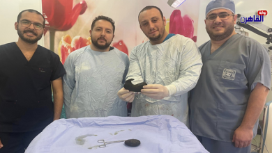 فريق جراحي بمستشفى أبو الريش ينجح في استخراج كتلتين شعر من أمعاء طفلة