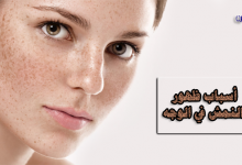 أسباب ظهور النمش في الوجه-علاج النمش في الوجه
