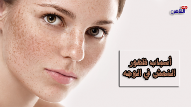 أسباب ظهور النمش في الوجه-علاج النمش في الوجه