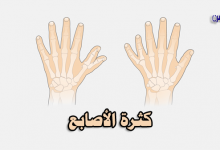 كثرة الأصابع