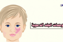 وحمات الجلد الدموية