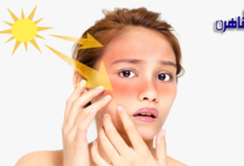 إزالة حروق الشمس من الوجه بسرعة