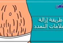 ما هي أسباب علامات التمدد-طريقة إزالة علامات التمدد بعد الولادة-الوقاية من علامات التمدد للحامل-علاج الاسترتش مارك الحمراء والبيضاء