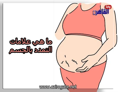 يوضح موقع بوابة القاهرة ما هي علامات التمدد بالجسم