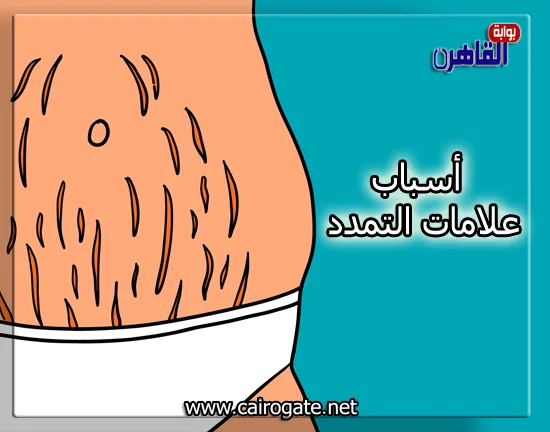 ما هي أسباب علامات التمدد-أسباب الاسترتش مارك