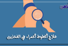 يوضح موقع بوابة القاهرة طريقة علاج الخطوط الحمراء في الفخذين في المنزل أو في الجسم